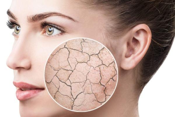 6 راه چاره برای جلوگیری از خشکی پوست