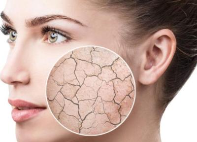 6 راه چاره برای جلوگیری از خشکی پوست